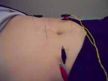 A person is getting acupuncture on their stomach.